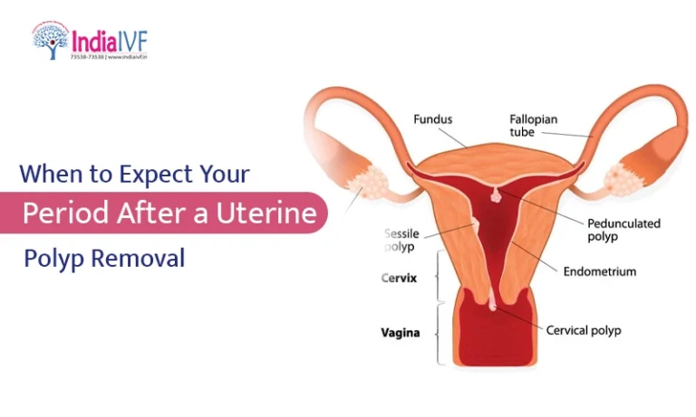 When to Expect Your Period After a Uterine Polyp Removal