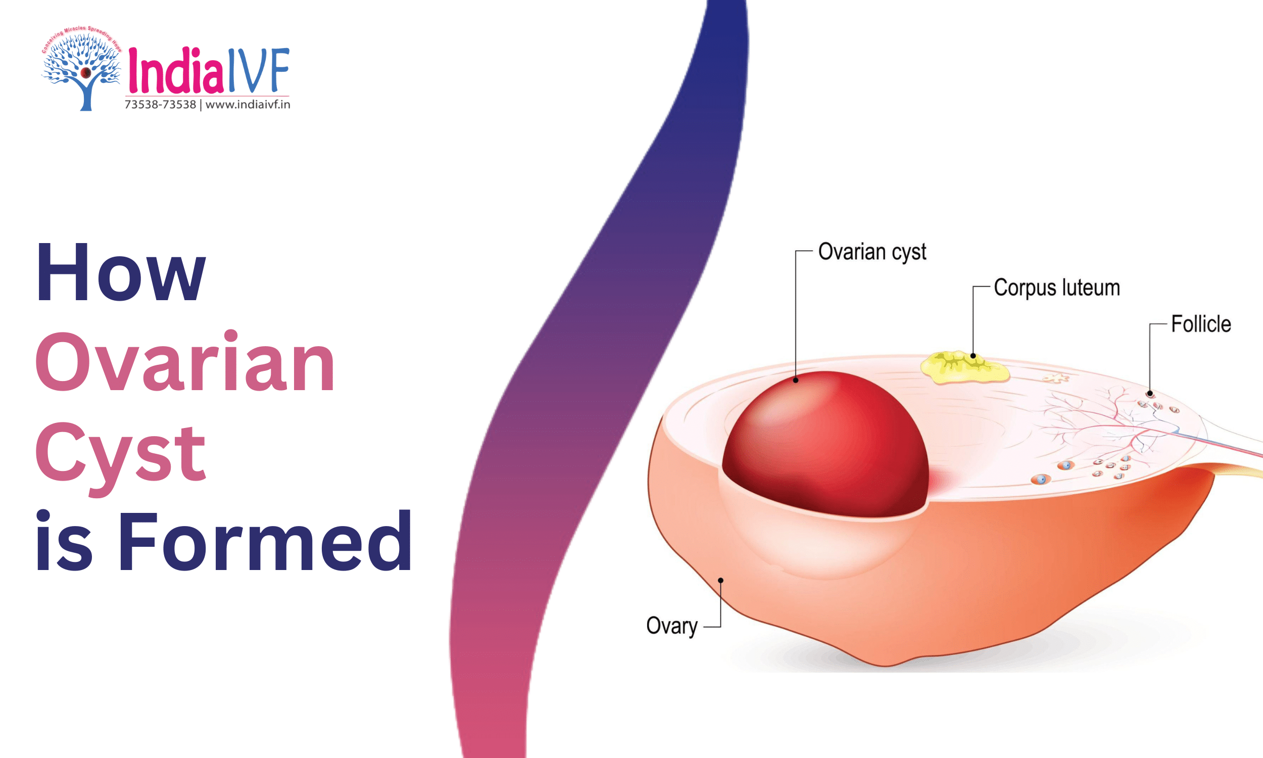 cjc 1295 ipamorelin cancer Sermorelin vs CJC-1295/Ipamorelin: Why Modern Medical Clinics Have Moved to  the Stack
