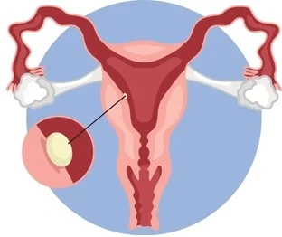 Higher Implantation