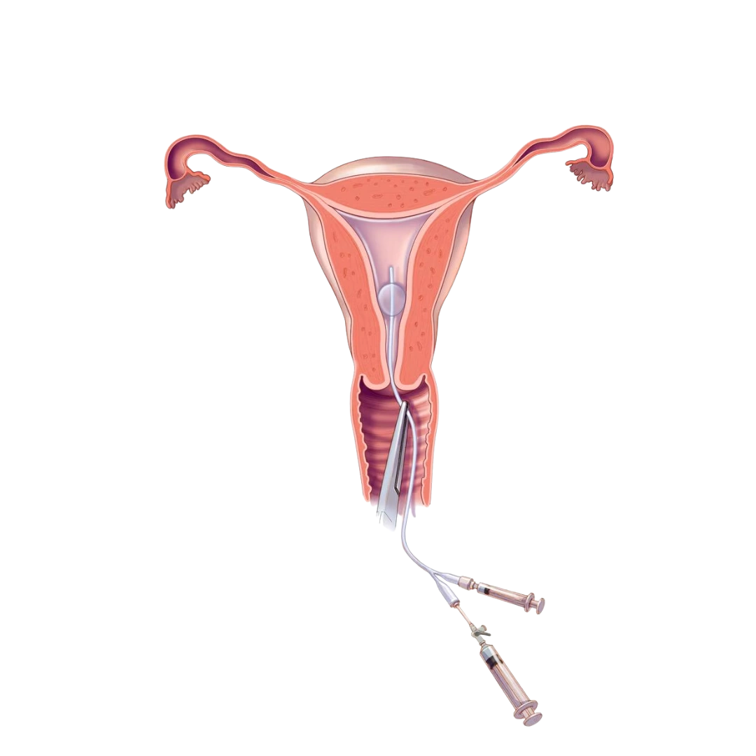 Female Infertility Treatment in Gwalior