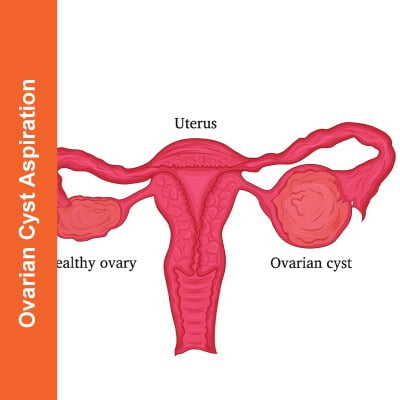 Ovarian-Cyst-Aspiration