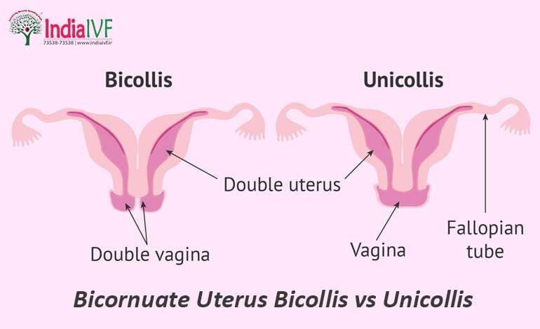 Bicornuate Uterus Unicollis vs Bicollis: Unveiling The Subtle Differences