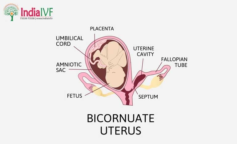 Bicornuate Uterus: Types and Their Implications for Fertility