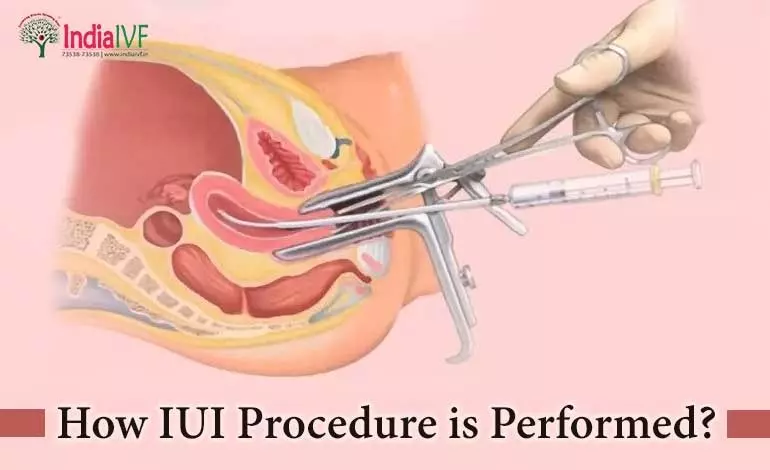 How IUI Procedure is Performed
