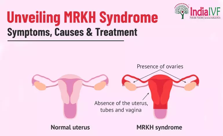 Unveiling MRKH Syndrome: Symptoms, Causes & Treatment at India IVF Fertility