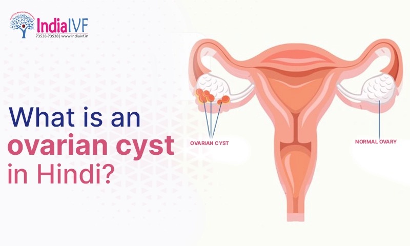 What is an ovarian cyst in Hindi?