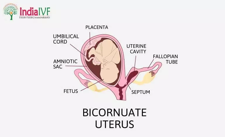 Bicornuate-Uterus