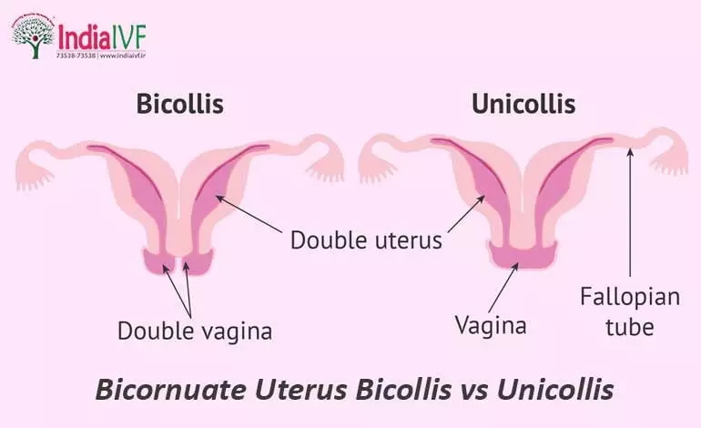 Bicornuate-Uterus-Unicollis