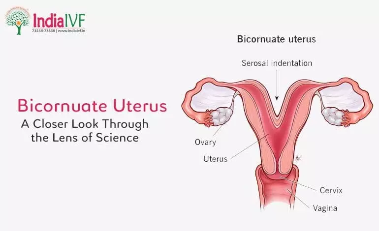 Bicornuate-Uterus