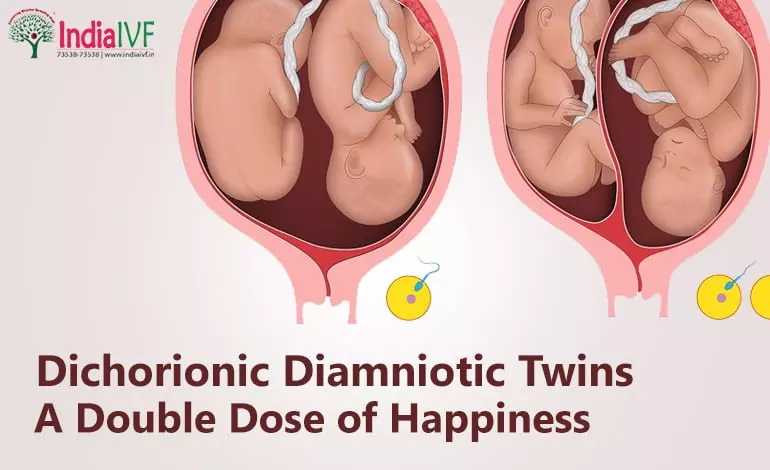 Dichorionic-Diamniotic-Twins