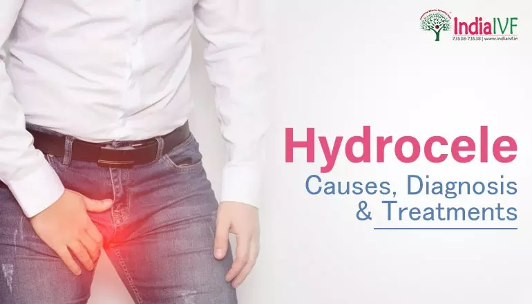 Hydrocele: Causes, Diagnosis & Treatments