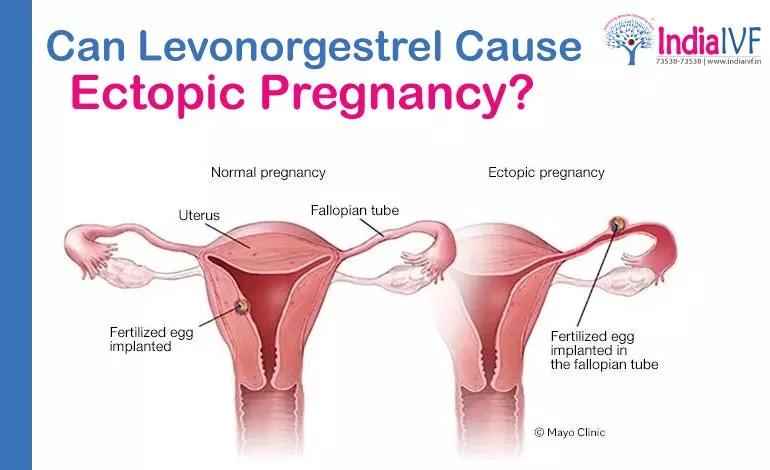 Levonorgestrel Cause Ectopic Pregnancy