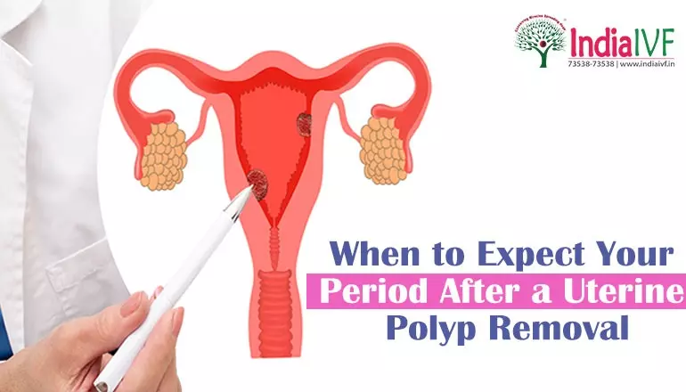When to Expect Your Period After a Uterine Polyp Removal