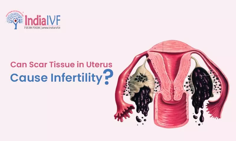 Can Scar Tissue in Uterus Cause Infertility?