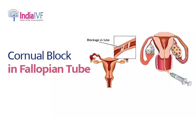 Cornual Block in Fallopian Tube