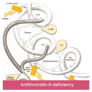 Antithrombin III deficiency