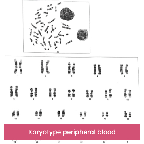 Karyotype peripheral blood