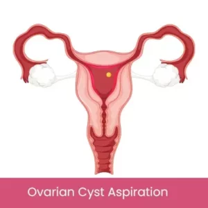 Ovarian Cyst Aspiration