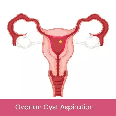 Ovarian Cyst Aspiration