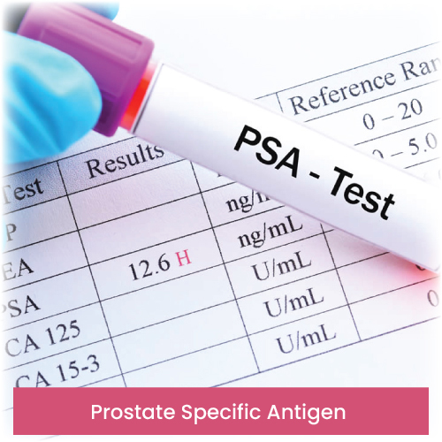 Prostate Specific Antigen