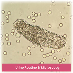 Urine Routine & Microscopy