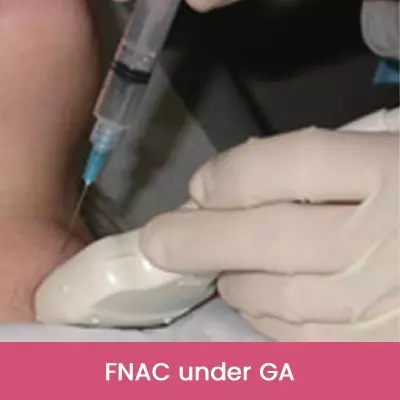 FNAC under GA