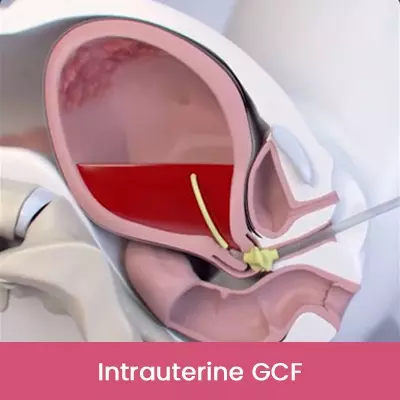 Intrauterine GCF