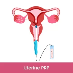 Uterine-PRP